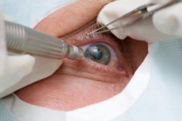 3 Loose Eyesight Due to Botched Cataract Surgery
