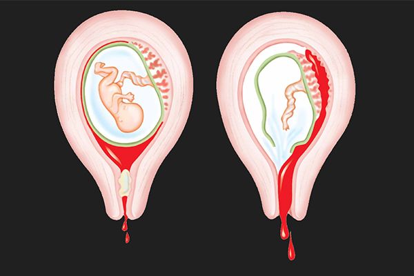 Doctors Can Now Abort 20-Week Foetus