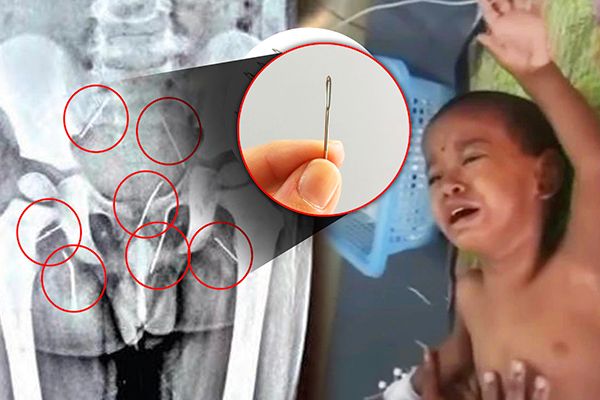 10 Needles Found Inside 3-year-old's Private Parts