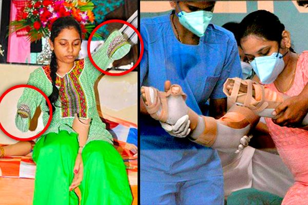 Monika More Mumbai’s First Hand Transplant Patient