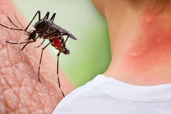 Home Remedies for Treating Mosquito Bites