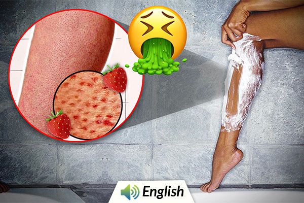 Strawberry Legs: Preventions & Treatment