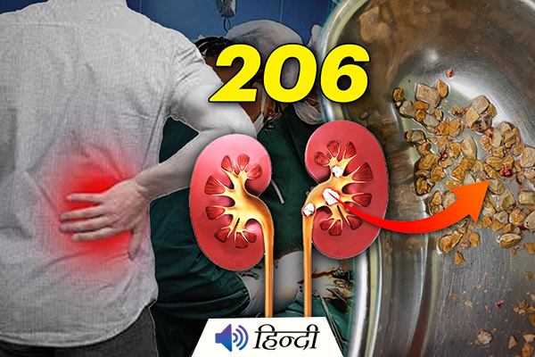 Man From Hyderabad Operated With 206 Kidney Stones