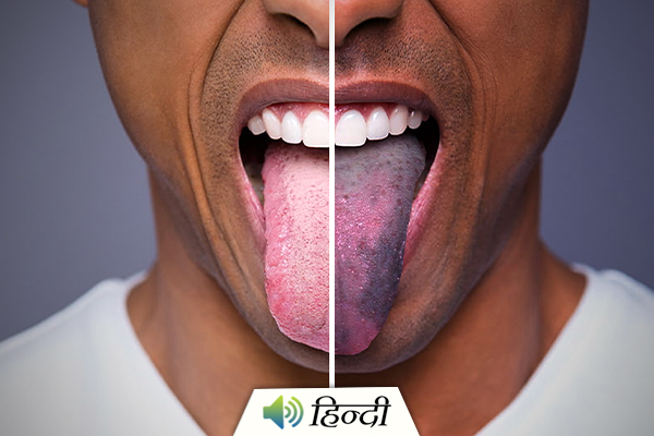Different Colours of the Tongue and Their Problems