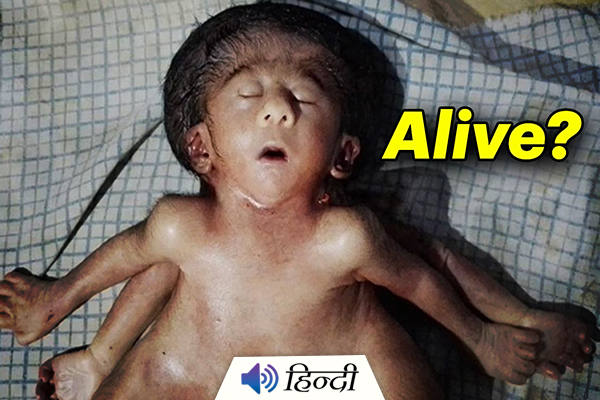 Bihar: Baby Girl Born With 4 Arms, 4 Legs, And 2 Hearts