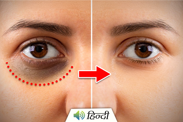 What Causes Dark Circles around Eyes and How to Prevent Them?