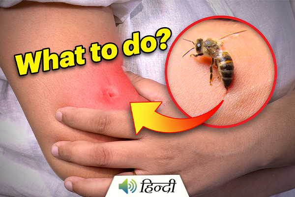 What to Do When You Get Stung by a Bee?