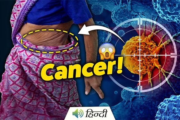 What Is Saree and Petticoat Cancer? Is It Real?