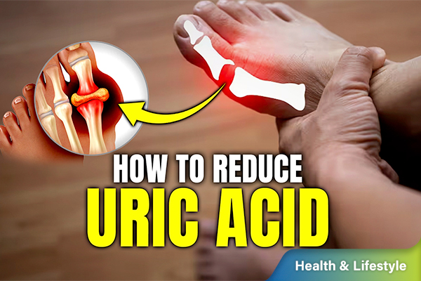 5 Natural Ways to Lower Uric Acid Fast